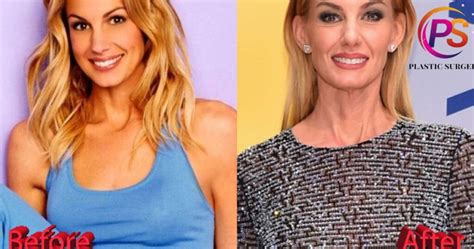 has faith hill had plastic surgery|Exploring Faith Hill’s Plastic Surgery:。